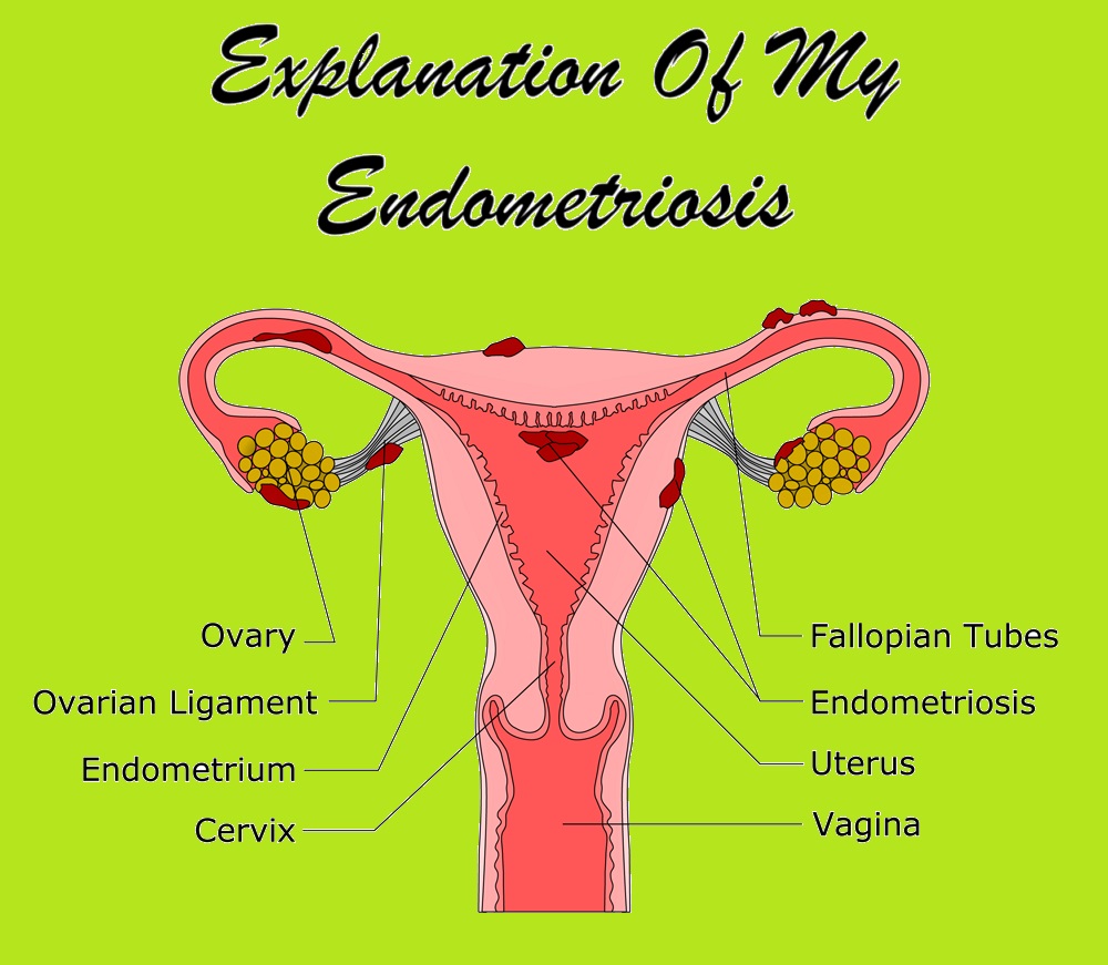 Pictures and Explanations of Endometriosis Findings